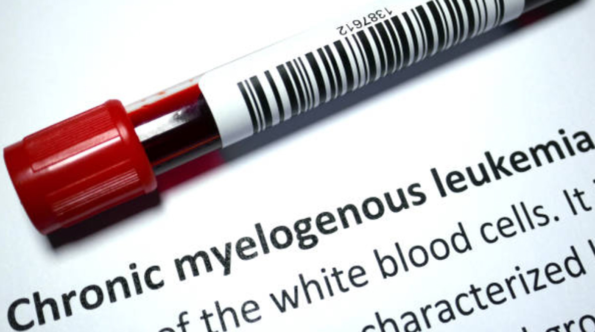 Chronic Myeloid Leukemia Symptoms Signs Causes And Treatments