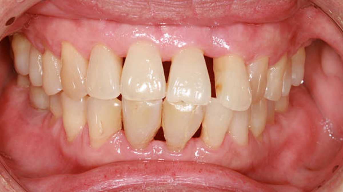 Gum Disease Treatments Remedies And Care 3765