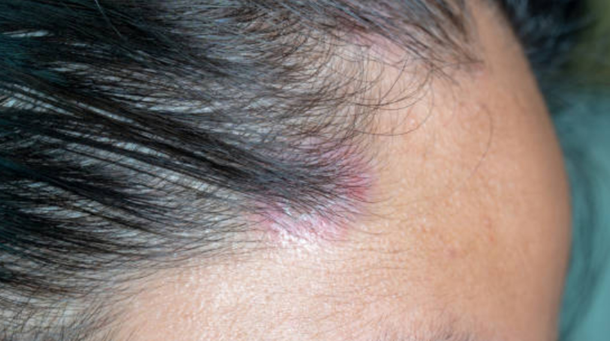 Scalp Psoriasis Symptoms Signs Causes Remedies And Treatments 6968