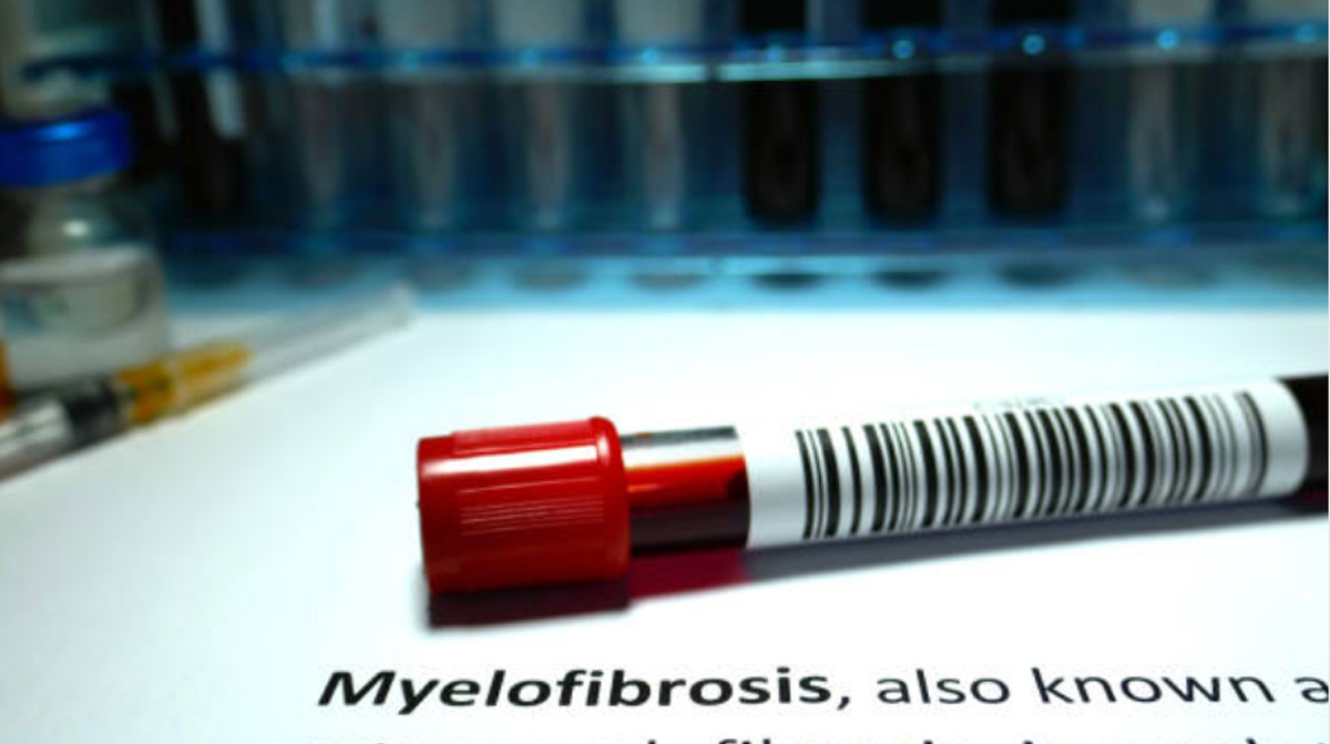 Myelofibrosis Symptoms, Signs, Causes, And Treatments